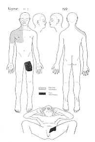 Fig. 3 Distribution of burns: case 2