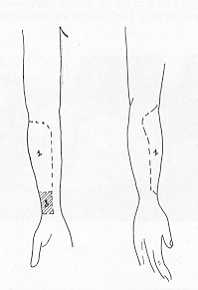 Fig. B La forme et les dimensions du lambeau chinois peuvent &re établies avec pr~cision en fonc ' tion des pertes de substances A recouvrir. Uessentiel est de rester centré sur I'axe vasculaire radial