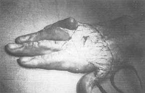 a - Placard cicatriciel tendu sur toute la face dorsale et  toutes les commissures 