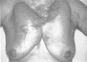 Fig. la Extensive scars of sternal and mammary region treated with two tissue expanders