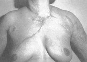 Fig. lb Post-operative view after complete removal of sternal and mammary scars and correction with a Z-plasty of an axillary scar. A correction of ptosis has also been obtained