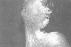 Fig. 2a Severe scar contracture of the neck: pre-operative view
