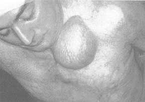 Fig. 2b Expansion of cervical region previously treated with mesh grafts