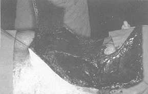 Fig. 2c Intra-operative view: large expanded flaps were raised and placed in Z-plasty manner to increase neck surface