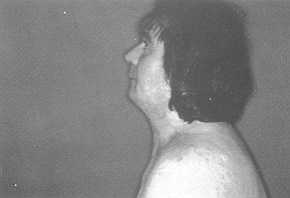 Fig. 2d Side post-operative view with elongation of neck skin