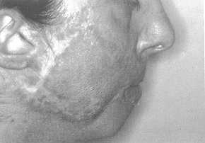 Fig. 3a Post-burn scar of the face (chin scars have already been removed by means of tissue expansion)