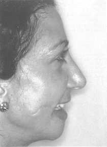 Fig. 3b Final photograph after complete removal of scar of the face, reconstruction of the auricular lobe and chin augmentation by osteocartilaginous tissue from septoplasty