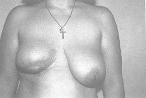 Fig. 4a Post-burn breast contracture: pre-operative view