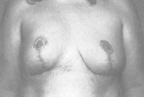 Fig. 4b Post-operative view after debridement and remodelling of the right breast and reduction mastoplasty of the left breast
