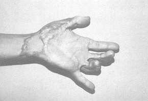 Fig. 5a Severe contracture of 3rd and 4th fingers and of the wrist. Pre-operative view