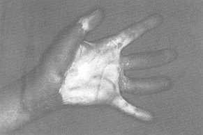 Fig. 5b Post-operative view after removal of scar tissue of the finger by cross-arm flap and of the wrist by abdominal flap