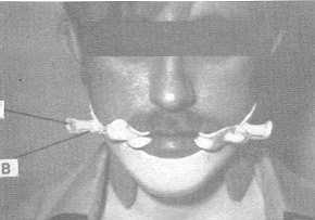 Fig. 2 - Orthèses pour la prevention de la microstomie (Walter C.)