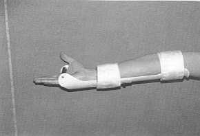 Fig. 6 Orth&se de position pour le coude 