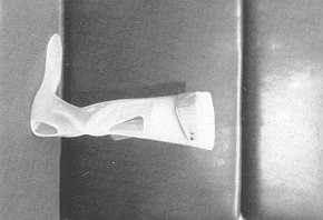 Fig. 9 Orth&se pour le complexe cheville-pied qui peat We utilise si la maladie due ~ la brlure a provoqu un dficit persistent de la flexion du dos du pied a cause d'une lesion nerveuse et/ou musculaire-tendineuse