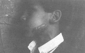 Photo 2a Cicatrice cheléfde du visage.