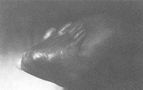 Photo 4a Syndactylie acquise.