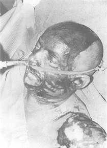 Fig. 1. Brûlure par vitriol: Monsieur F., 44 ans; brûlure du 3eme degré du visage, atteinte cornéenne bilatérale; brûlure du 3eme degré membre supérieur gauche; 11% de la surface corporelle-, 60 jours d'hospitalisation; lourdes séquelles esthétiques et fonctionnelles.