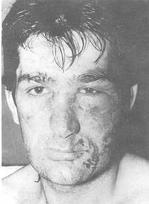 Fig. 2. Brûlure par acide sulfurique pur: Monsieur G., 32 ans; brûlure 2eme degré superficiel médio-facial, ulcération cornéenne de l'oeil droit; 1 jour d'hospitalisation; cicatrisation sans séquelle en 3 semaines.