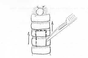 Fig. 5. Trachéotomie. Volet à charnière inférieure.