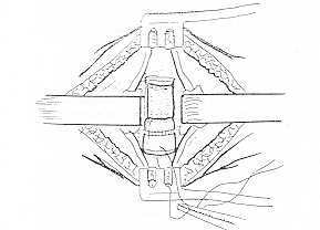 Fig. 6. Trachéotomie. Amarrage du volet à la peau.