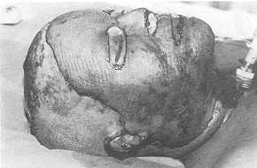 Phot. 2. Trachéotomie pour chirurgie restauratrice et esthétique d'une brûlure grave de la face.
