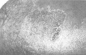 Fig. 2. c) The same donor site at 3 months.