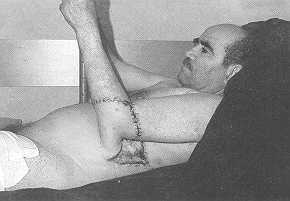 Fig. 1- a. Covering with abdominal nap of torpid ulcer occurring after excision performed in another hospital of carcinoma in burn sequela on left elbow 