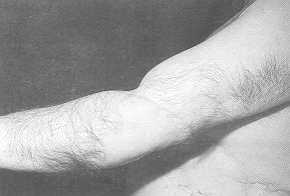 Fig. 1 - b. Long-term flap check-up