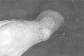 Fig. 1 - c. Recidivation ofneoformation on burn scar appearing after about 8 years in distal third of left forearm in same person 