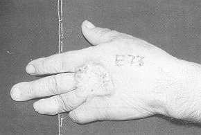 Fig. 2 - a. Neoformation in burn scar on dorsal surface of left hand