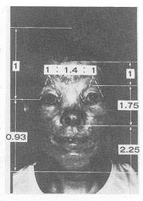 Fig. 2 Leonard's ratios of Case 1. Longitudinal narrowing in the upper two thirds is noticed.