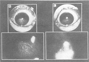 Fig. 5 The condition of the eyeballs of Case 1.