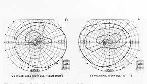 Fig. 6 The field of visual acuity of Case 1.