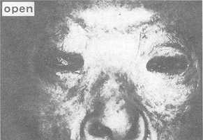 Fig. 10 Lagophthalmos with eyelids open and closed.