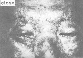 Fig. 10 Lagophthalmos with eyelids open and closed.