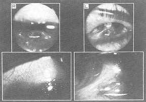 Fig. 11 The condition of the eyeballs of Case 2.