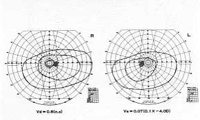 Fig. 12 The field of visual acuity of Case 2.