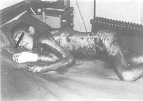 Fig. I Ten-year-old boy after conflagration with spirit. The burned area was estimated at 65%.