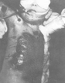 Fig. 2, 3 Covering with mesh graft in a five-year-old girl burned with hot water.