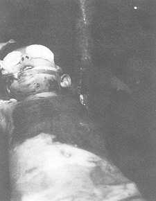 Fig. 2, 3 Covering with mesh graft in a five-year-old girl burned with hot water.