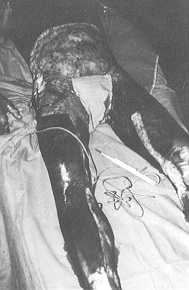 Photo 1: l ère avulsion à J3