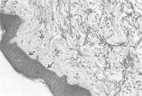 Fig. 1 At maximum expansion: thickened epidermis, subpapillary oedema, fragmentation of elastic fibres (orcein stain).