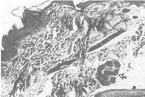 Fig. 2 At maximum expansion: decreased thickness of dermis, thick collagen bundles; sweat and sebaceous glands normal but with the subcutaneous fat (Mallory stain).