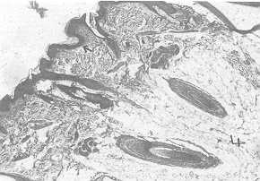 Fig. 3 At maximum expansion: effaced rete ridges, subcutaneous fat herniatio ' n and skin appendages within subcutaneous fat (haematoxylin and eosin stain).