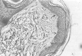 Fig. 4 Three months after removal of expander: rete ridges still effaced but elastic fibres become more oriented (orcein stain).