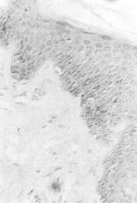 Fig. 5 Increased acid mucopolysaccharides (Alcian blue stain).