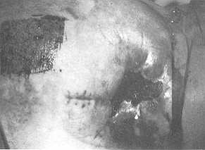 Fig. I Donor site that has been just sampled.