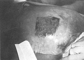 Fig. 2 During application of the hydrocolloid dressing.