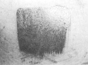 Fig. 3 Donor site healed at day 7.