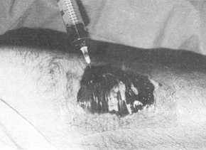 Fig, 4 In some cases, it was necessary to aspirate some exudate without any change of the plaque.
